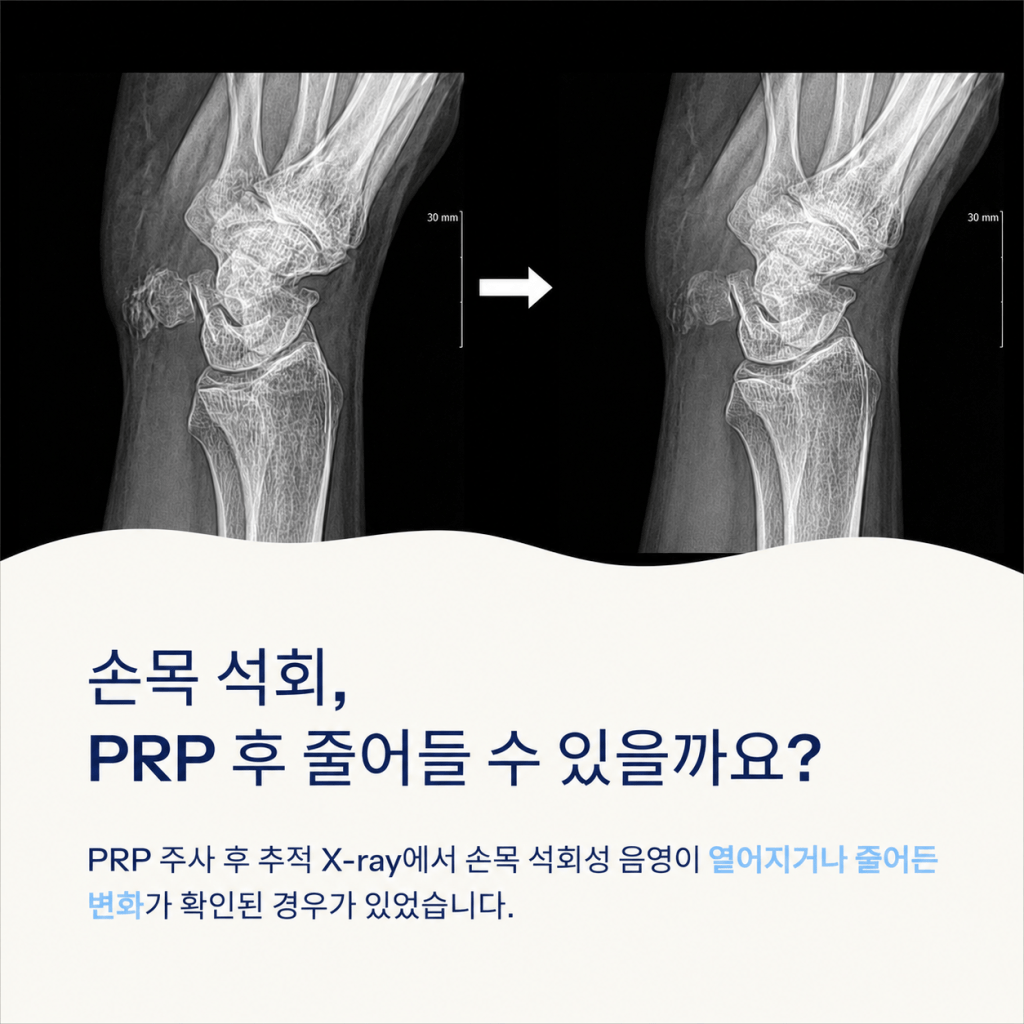의왕 PRP주사 후 손목 석회성 음영 변화와 X-ray 추적 확인