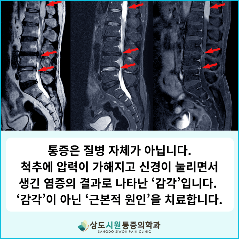 허리디스크와 척추관협착증 MRI에서 신경 압박 원인을 설명하는 상도시원마취통증의학과 이미지